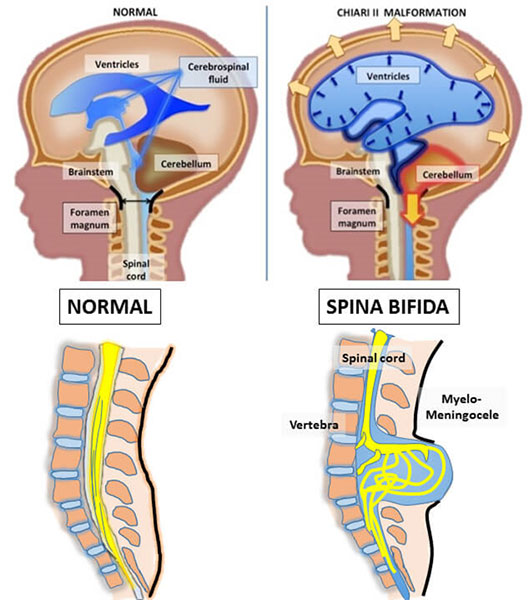 spina-bifida-image